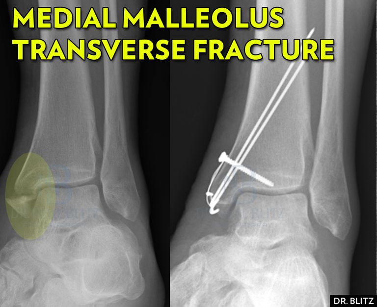 articulation cheville, malléole médiale, fractures malléolaires, fractures cheville, fractures malléolaires médiales