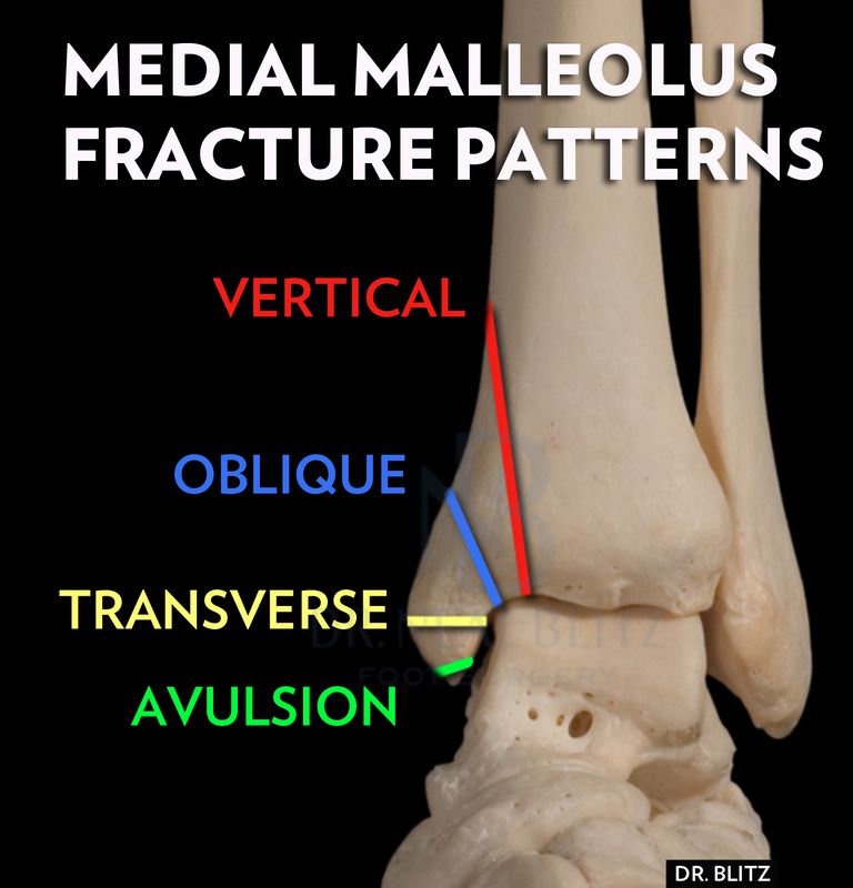 articulation cheville, malléole médiale, fractures malléolaires, fractures cheville, fractures malléolaires médiales