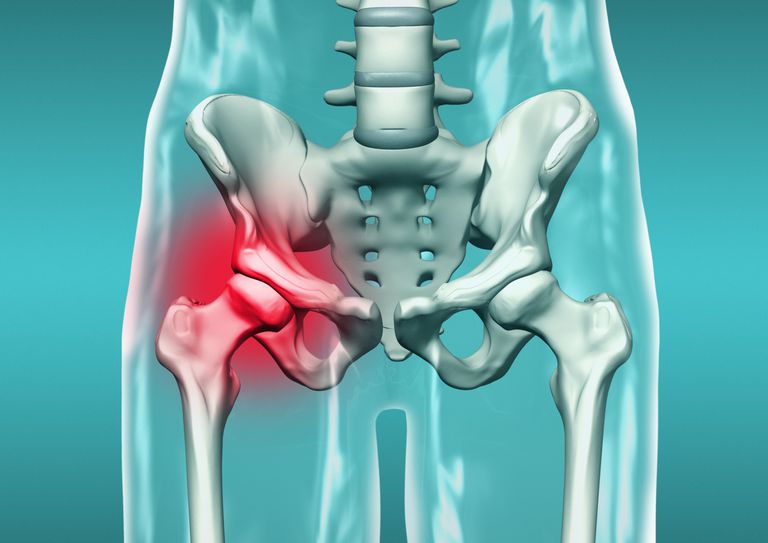 articulation hanche, fracture acétabulaire, fractures acétabulaires, acétabulaire produit