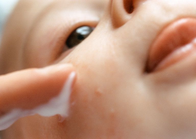 acné infantile, votre enfant, acné chez, acné nouveau-né