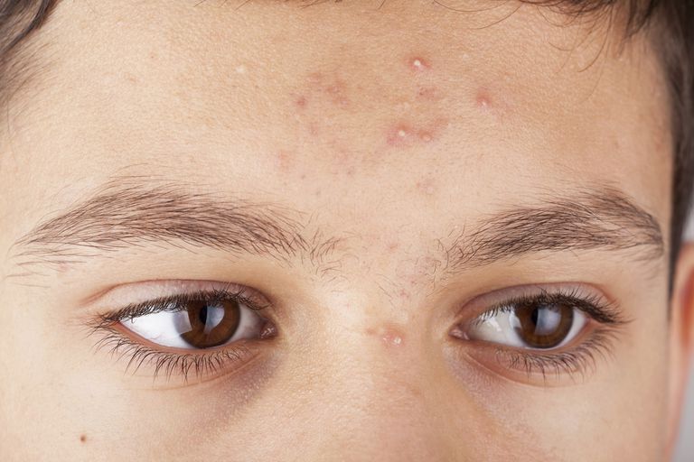 pustules sont, vous avez, vous pouvez, contre acné, dans pore, ébullition furoncles