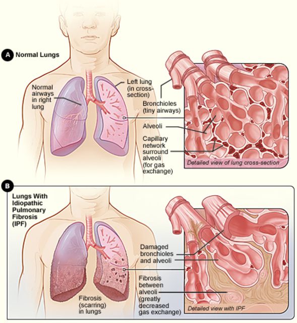 fibrose pulmonaire, fibrose pulmonaire idiopathique, pulmonaire idiopathique, Cette maladie, avec maladie