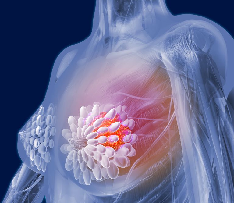 cancer sein, diagnostiqué chez, sein peut, angiosarcome sein