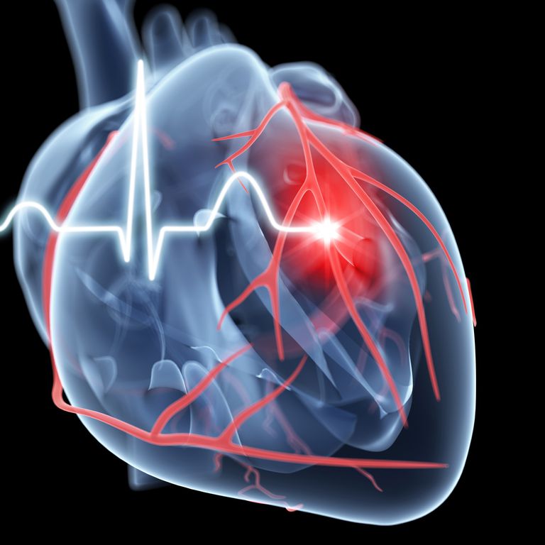 inhibiteurs PCSK9, événements cardiovasculaires, chez participants, crises cardiaques, étude FOURIER