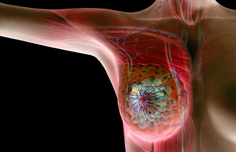 cancer sein, peut être, peuvent être, kystes mammaires, tissu mammaire