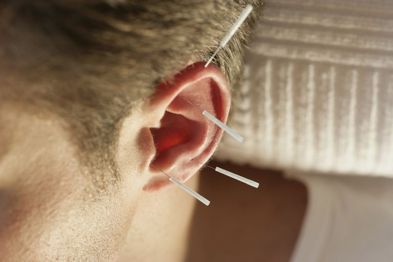 acupuncture oreille, acupuncture auriculaire, dans Journal, dans traitement, acupuncture oreille peut, auteurs étude