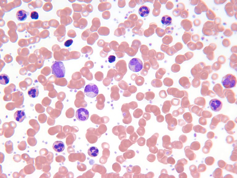 cellule cancéreuse, cellules tueuses, globules blancs, lymphome Hodgkin