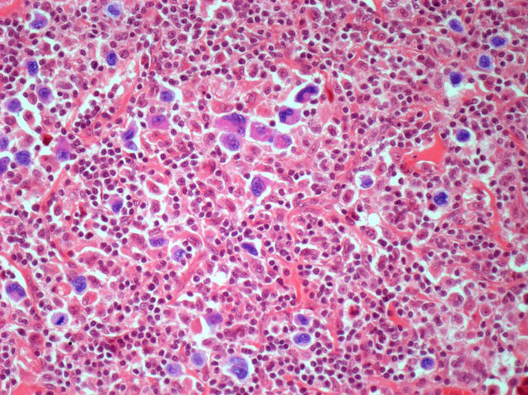 cellule cancéreuse, cellules tueuses, globules blancs, lymphome Hodgkin