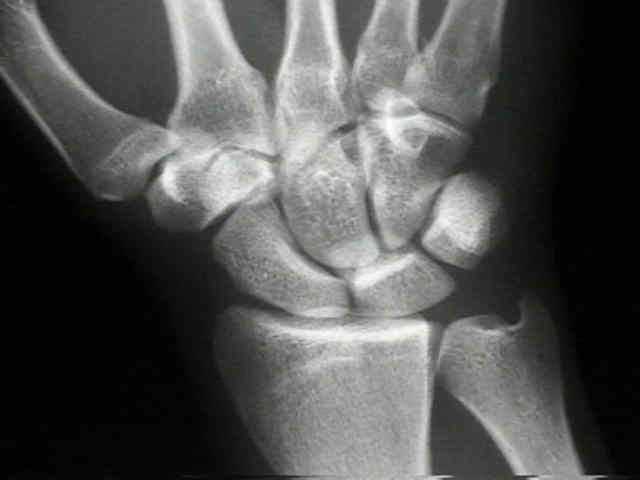 peut être, poignet cassé, articulation poignet, fracture poignet, fractures poignet, intervention chirurgicale