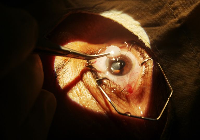 chirurgie cataracte, après chirurgie, peut être, après chirurgie cataracte