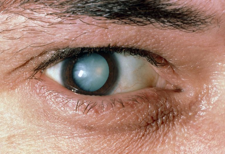 cataractes sont, chirurgie cataracte, peuvent être, vous avez, capsule cristallin