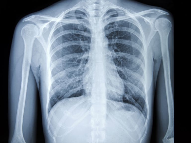 cancer poumon, radiographies thoraciques, radiographie pulmonaire, cancers poumon, facteurs risque, radiographie thoracique