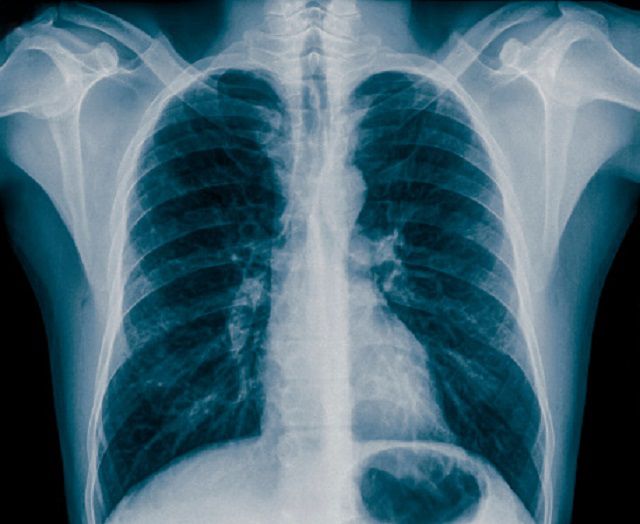 radiographie thoracique, dans cadre, exposition rayonnements, faisceaux rayons, insuffisance cardiaque