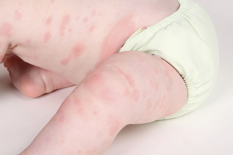 votre enfant, réaction allergique, allergies pénicilline, allergie pénicilline