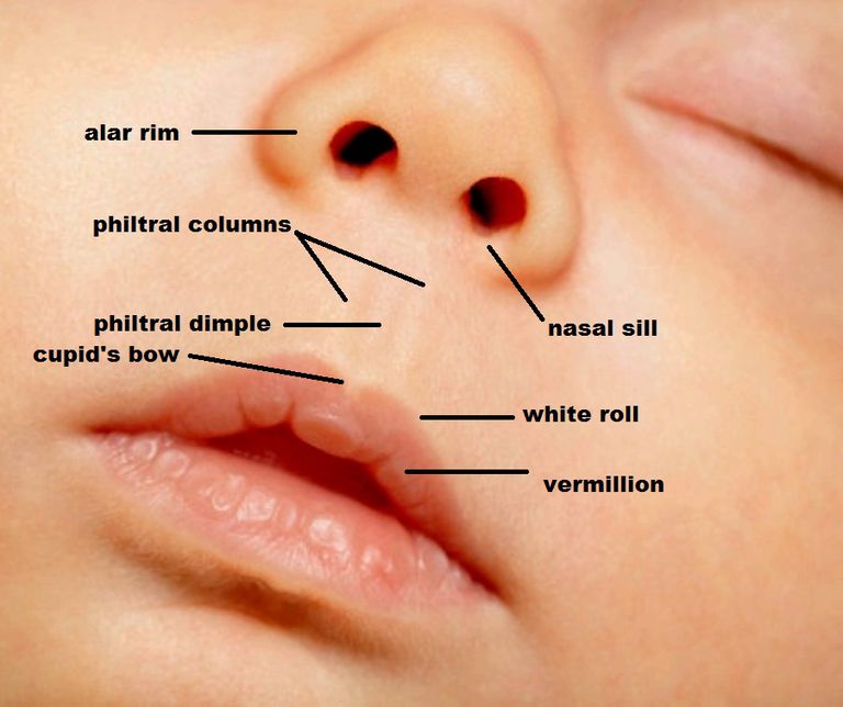 fente labiale, lèvre supérieure, labiale complète, peut être, fente labiale complète