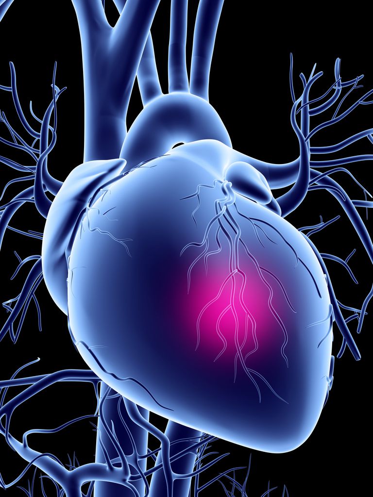artères coronaires, cathétérisme cardiaque, dans artères, dépôts calcium, infarctus myocarde, muscle cardiaque