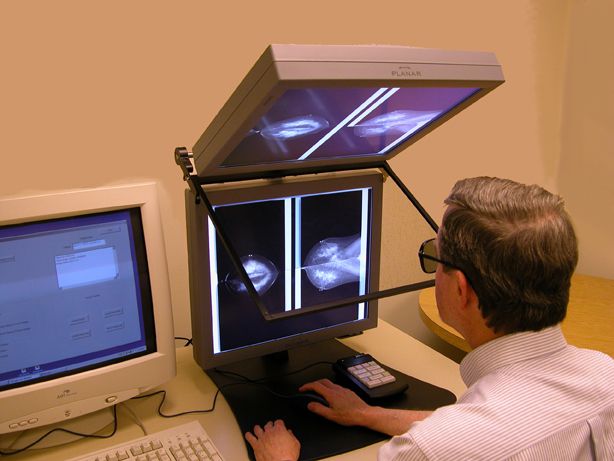 mammographie numérique, mammographies numériques, mammographie numérique stéréoscopique, numérique stéréoscopique, tissu mammaire, vous avez