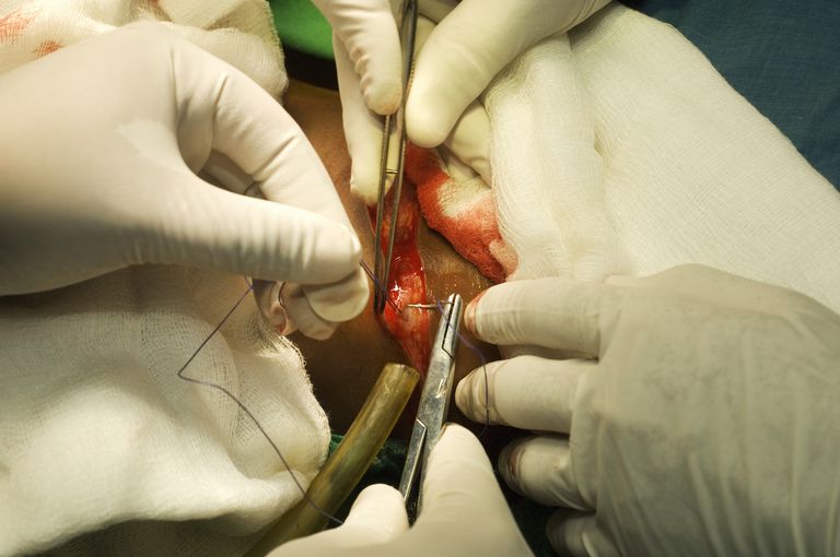 hernie discale, pour hernie, cicatrisation post-chirurgicale, discectomie ouverte, peut être