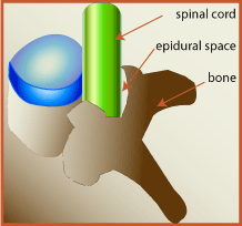 moelle épinière, colonne vertébrale, espace épidural, hernie discale