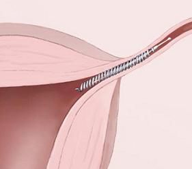 procédure Essure, trompes Fallope, ligature trompes, dans utérus