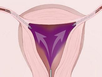 procédure Essure, trompes Fallope, ligature trompes, dans utérus