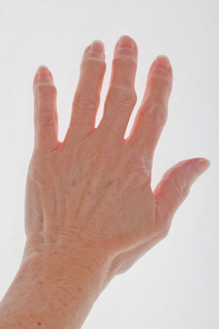 arthrite digitale, articulations doigts, peuvent être, polyarthrite rhumatoïde, éperons osseux