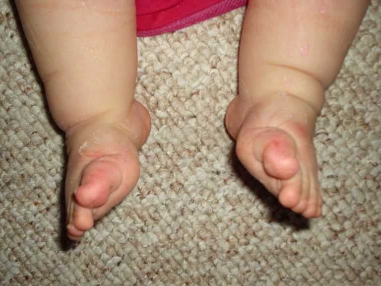 votre bébé, orteils bouclés, vertical congénital, bébé orteil, chez nouveau-nés, deux pieds
