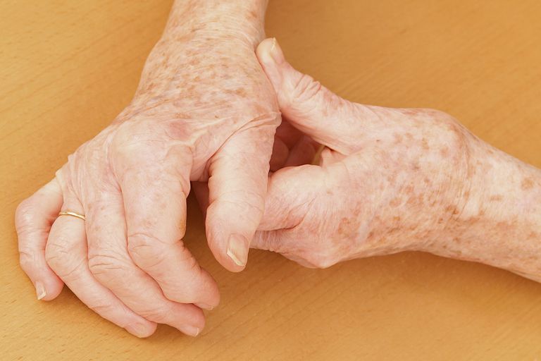 arthrose main, arthrose mains, appelés nœuds, arthrose tests, arthrose tests sanguins