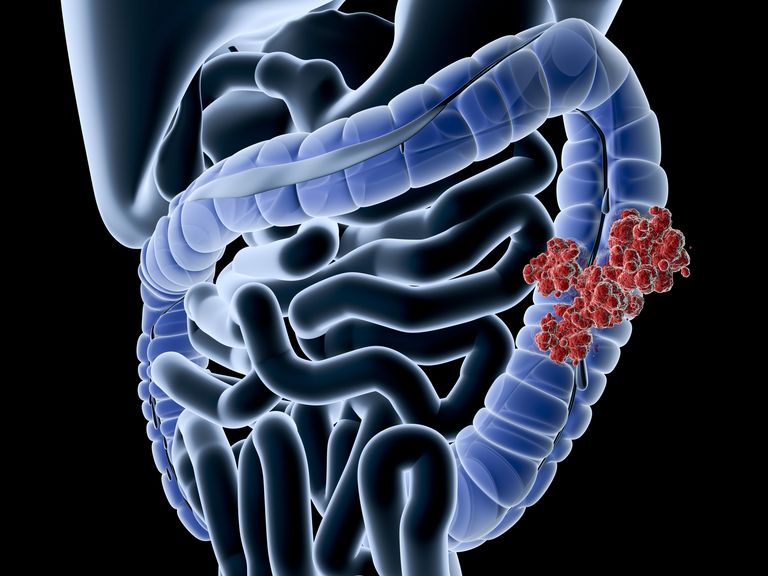 maladie Crohn, colite Crohn, intestin grêle, patients atteints