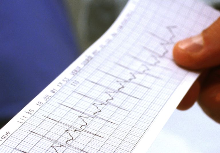 fréquence cardiaque, personnes atteintes, population générale, tachycardie posturale