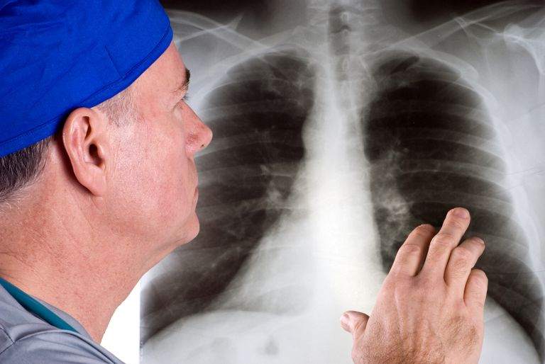 cancer poumon, cellules cancéreuses, peut être, voies respiratoires, diagnostic cancer