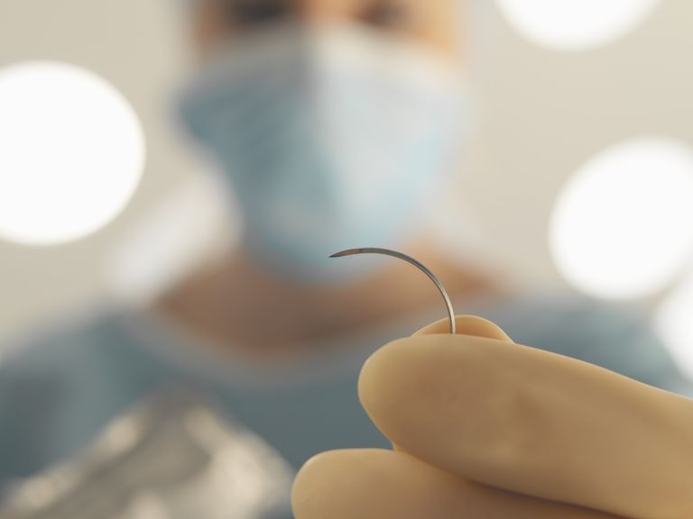 sutures résorbables, votre incision, points suture, résorbables sont, sutures résorbables sont