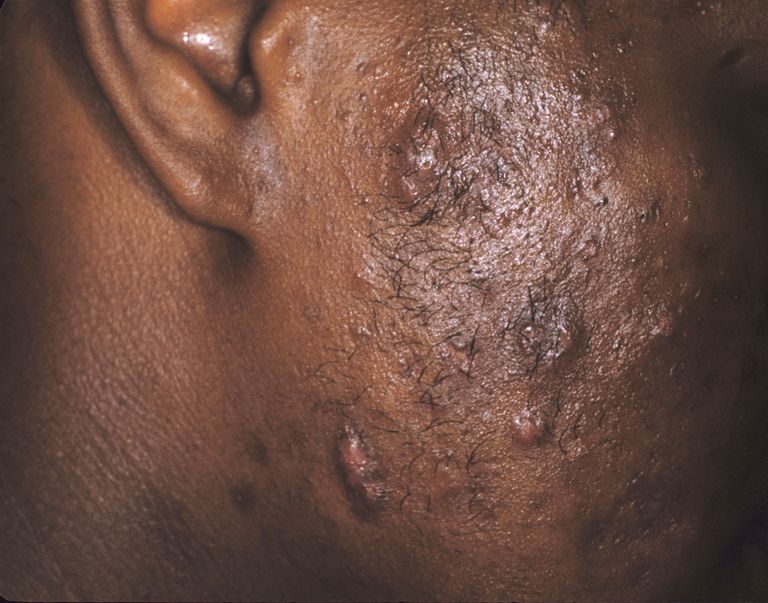 acné sévère, contre acné, antibiotiques topiques, peut être, rétinoïdes topiques, voie orale