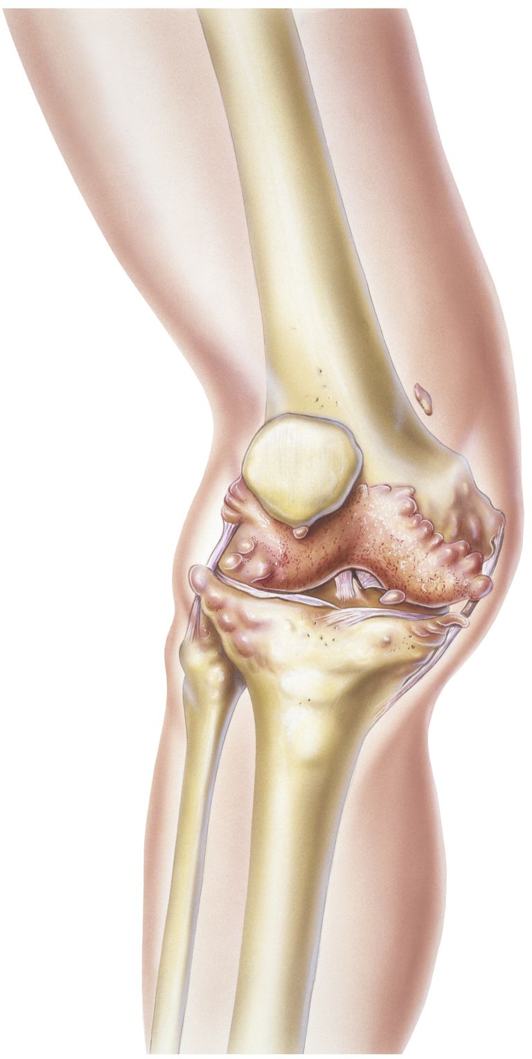 polyarthrite rhumatoïde, joint permet, type joint, type joint permet, sont articulations