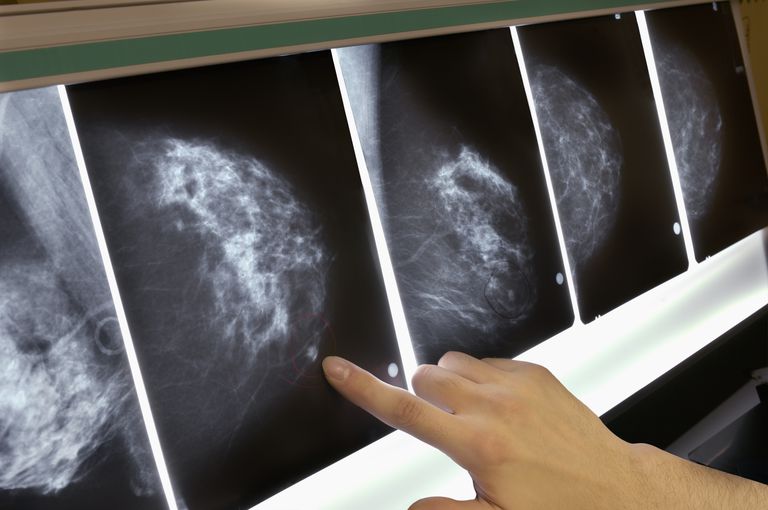 cancer sein, gènes BRCA, masse contour, montre masse