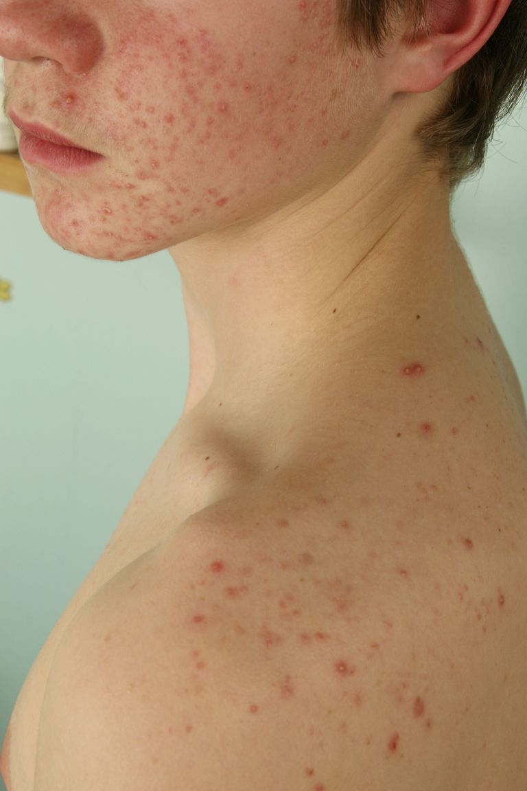 acné inflammatoire, traitement acné, votre acné, acné inflammatoire légère, acné vente, acné vente libre