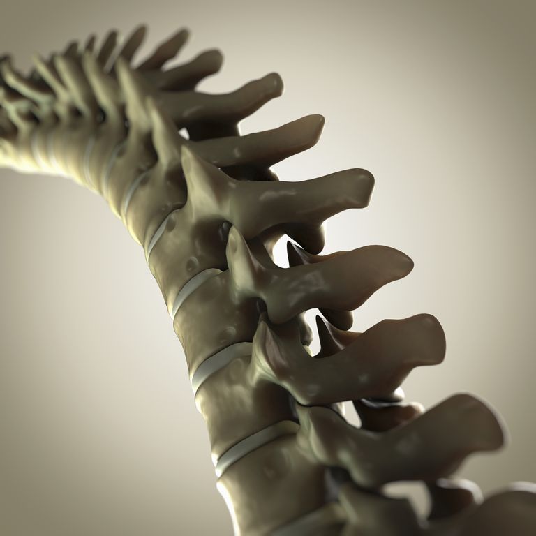 colonne vertébrale, articulation intervertébrale, articulations intervertébrales, fusion spinale, cage fusion, chirurgie scoliose