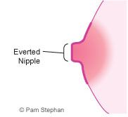 mamelons inversés, inversion mamelon, rétraction mamelon, cancer sein, mamelons sont, peut être