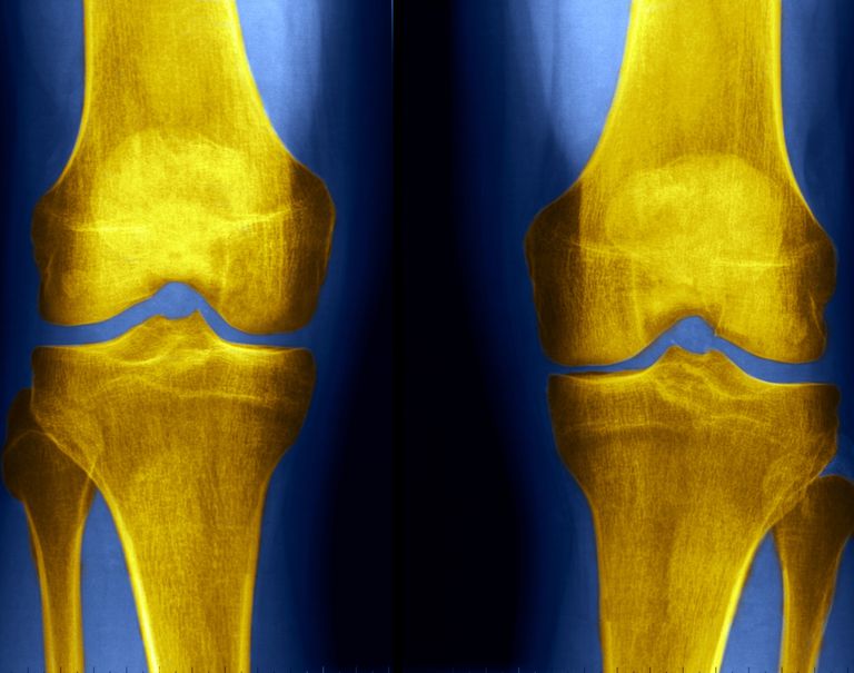 radiographies genou, problèmes genou, rayons sont, arthrite précoce