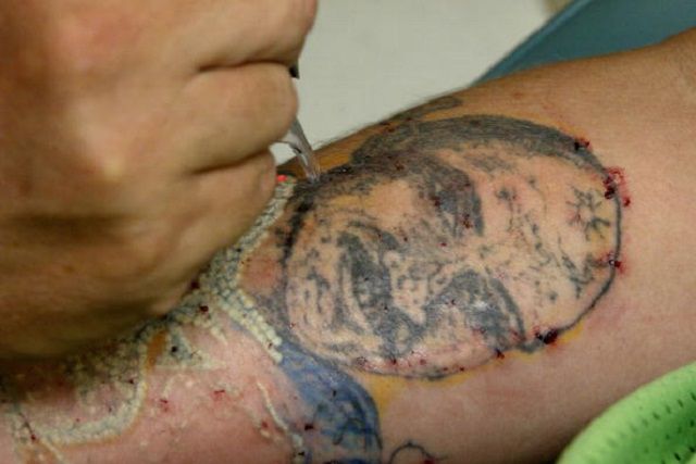 tatouage laser, enlèvement tatouage, enlèvement tatouage laser, autres méthodes