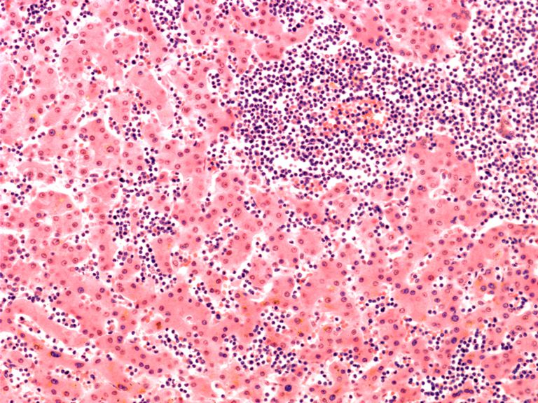 globules blancs, leucémie sont, risque leucémie, autres types