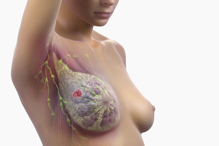 ganglions lymphatiques, dans ganglions, dans ganglions lymphatiques, sous bras, cancer sein, cancer trouve