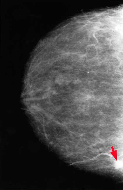 cancer sein, tissu mammaire, mammaire dense, tissu mammaire dense, votre médecin, sont tissus