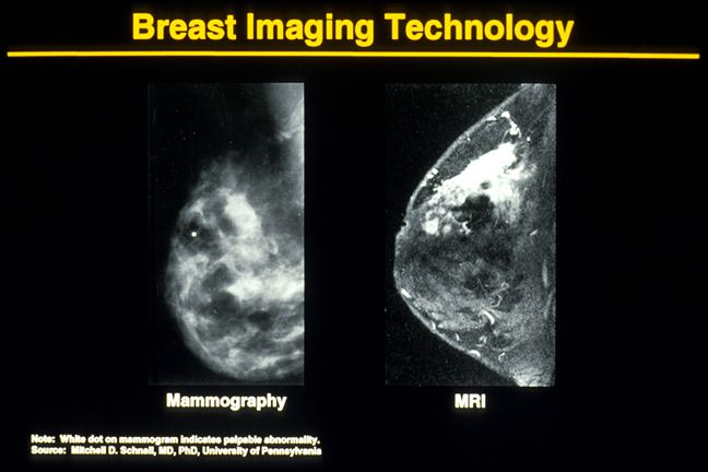 cancer sein, tissu mammaire, mammaire dense, tissu mammaire dense, votre médecin, sont tissus