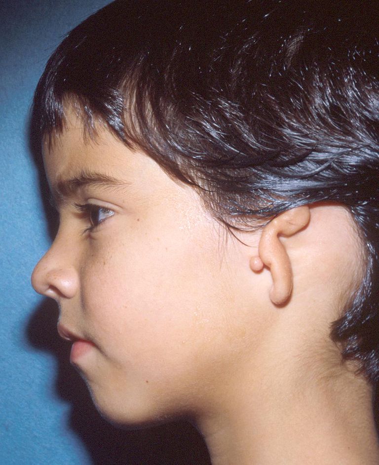 oreille interne, oreille externe, perte auditive, prothèse auditive, atteints microtie, oreille droite