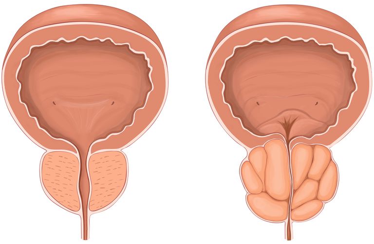 système Rezūm®, bénigne prostate, chez hommes, Cleveland Clinic