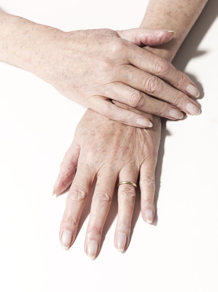 psoriasis ongles, peut être, maladie ongles, mois pour, sont souvent, apremilast Otezla