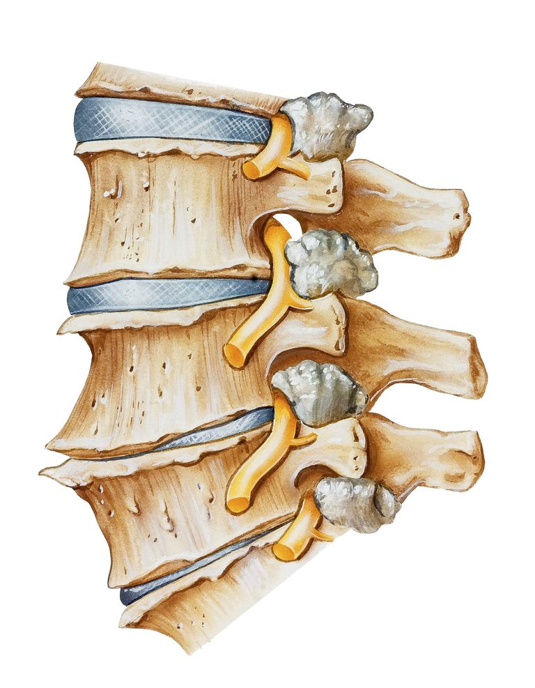 colonne vertébrale, sténose neuroforaminale, canal central, sténose canal