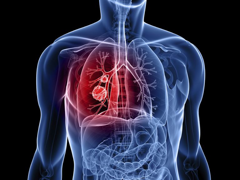 cancer poumon, petites cellules, poumon petites, poumon petites cellules, cancer poumon petites