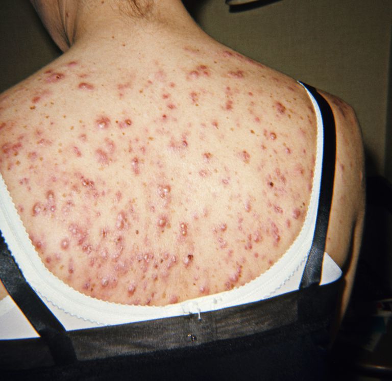acné nodulocystique, acné kystique, kystes sont, acné inflammatoire